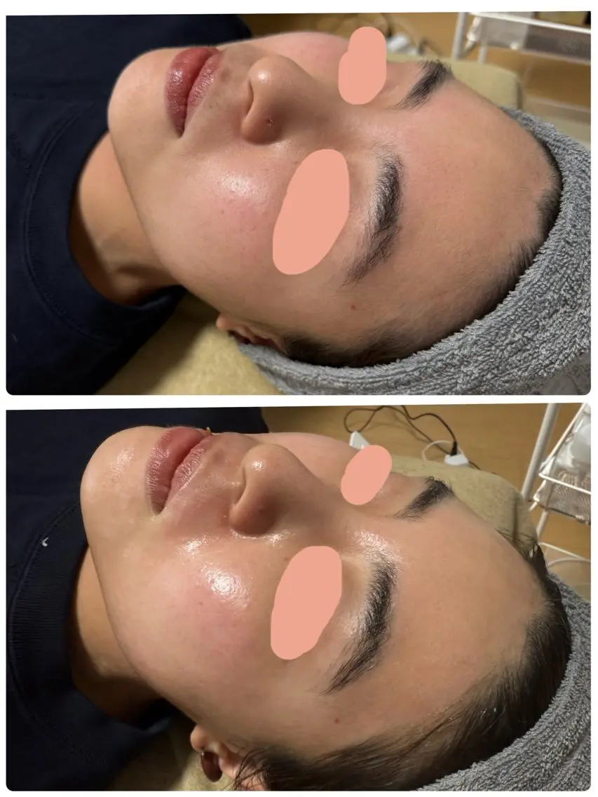 脱毛 enine フェイスWAXのエステ・リラクイメージ