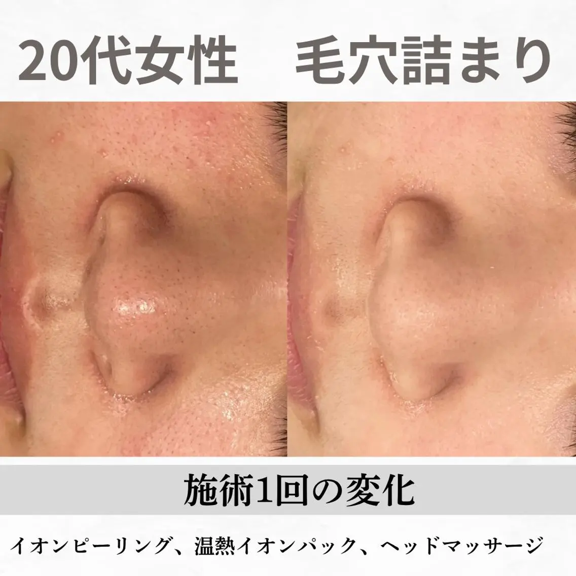 重度ニキビ専門🌷 ダウンタイムなしのエステ・リラクイメージ