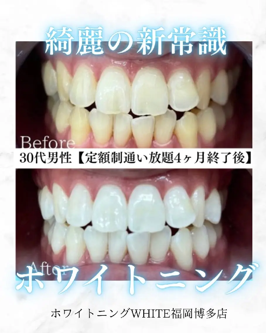 メンズ キッズ 撮影モデル セルフホワイトニング WHITE福岡博多店のエステ・リラクイメージ