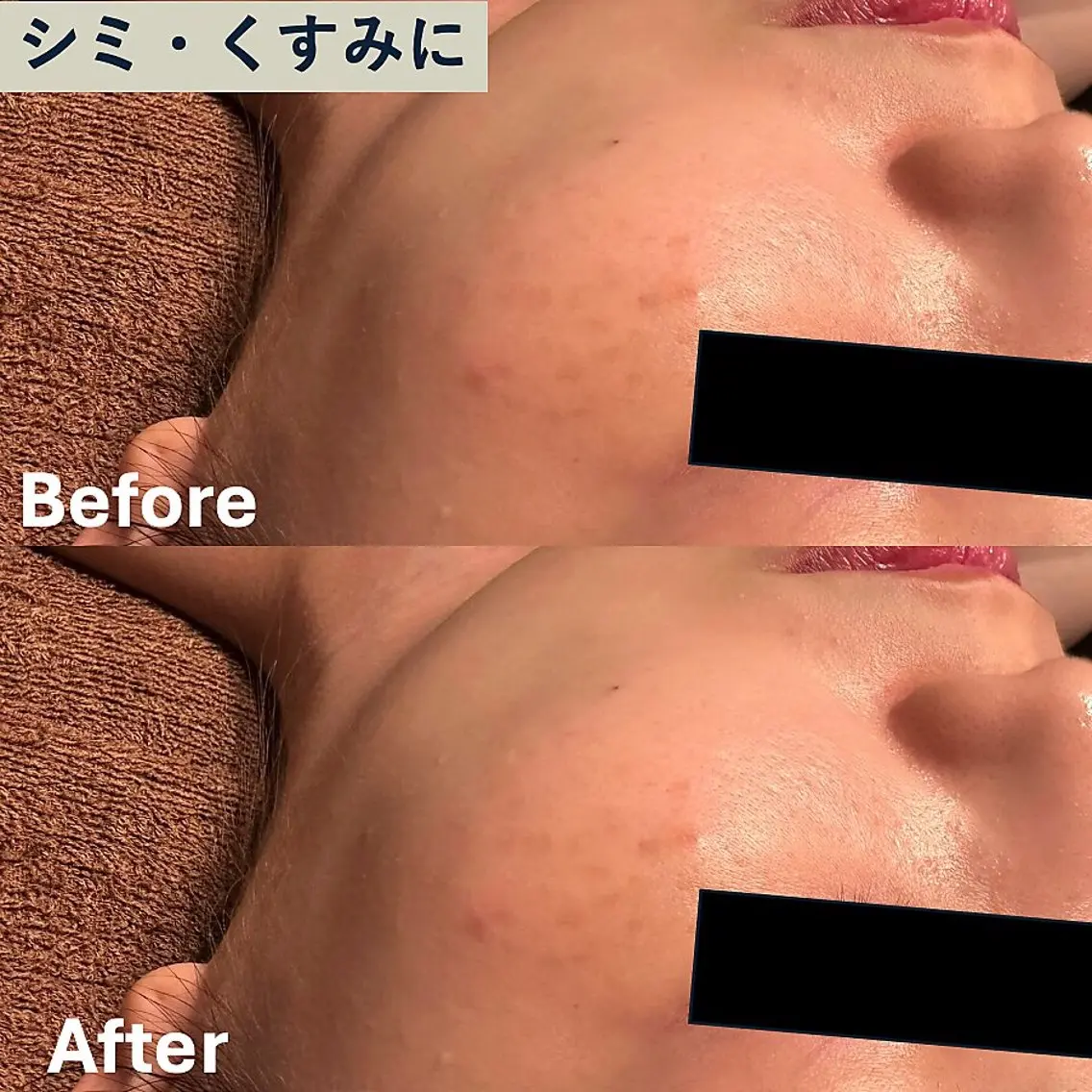 【くすみに】高濃度酸素注入+高速タッピングで美肌を実現🫧の写真