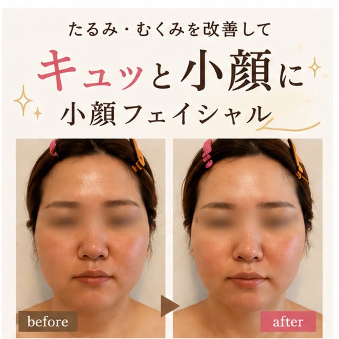 《ミニモ限定》45分＊小顔&リフトupフェイシャルパック8,900円→5,900円の写真