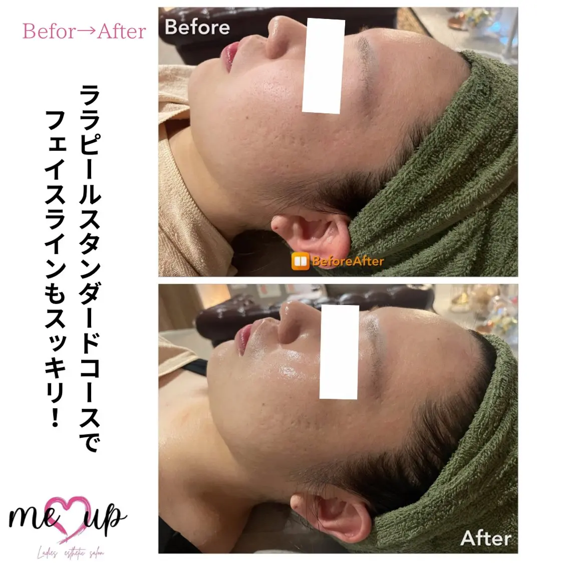 エステ Meupニキビ専門店 背中/ハーブ/肌管理のその他イメージ