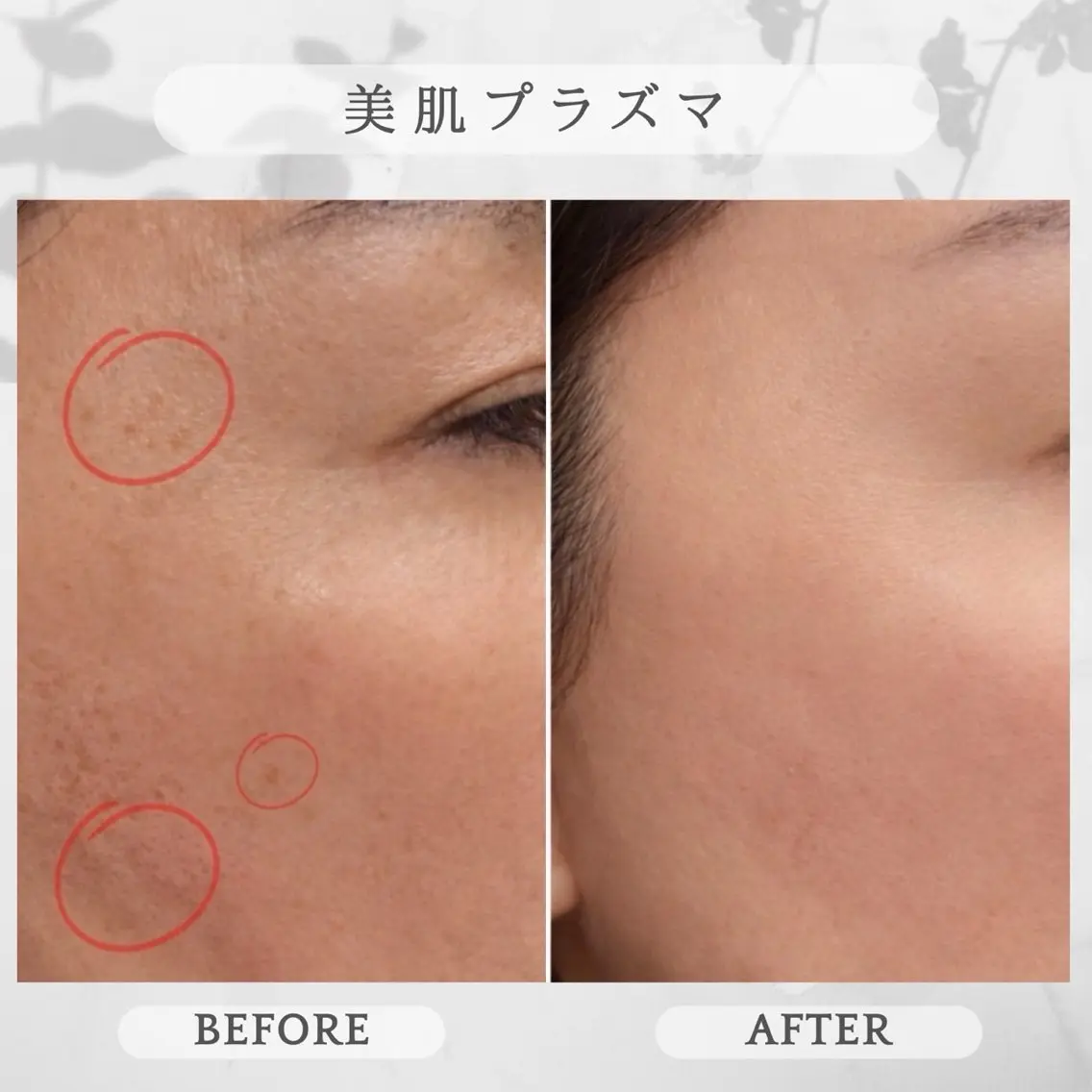 💎美肌プラズマ💎《シミ・黒ずみが気になる方》の写真