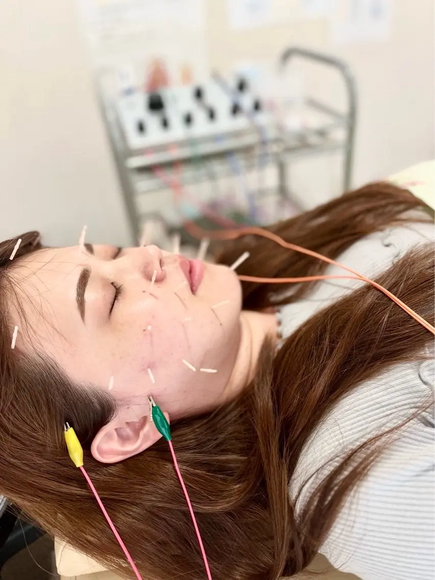 その他 リフトアップ・たるみ ☆美容鍼小顔矯正のその他イメージ