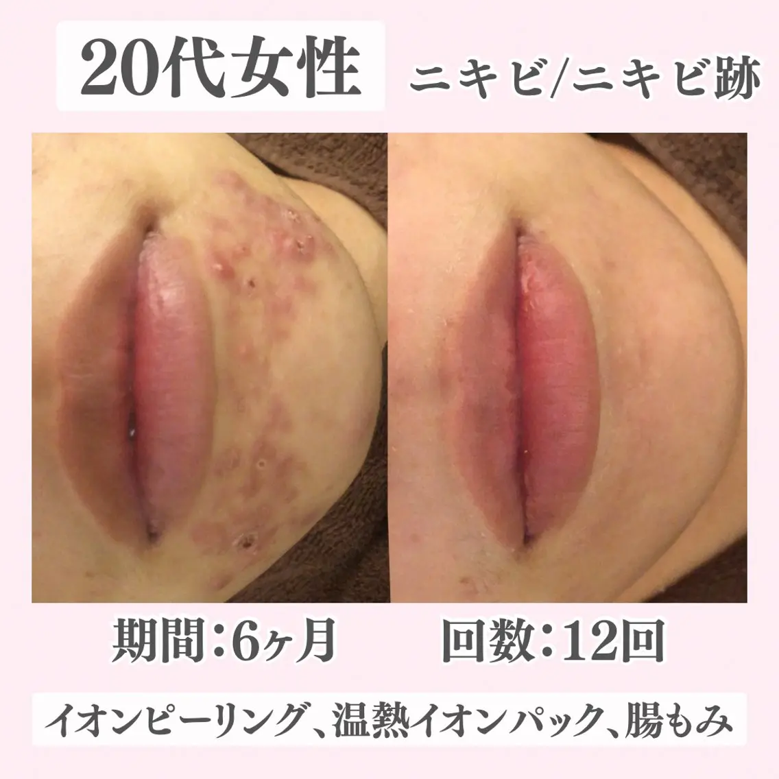 エステ リラク ニキビ・肌質改善専門 ♡人生が変わるサロンのエステ・リラクイメージ