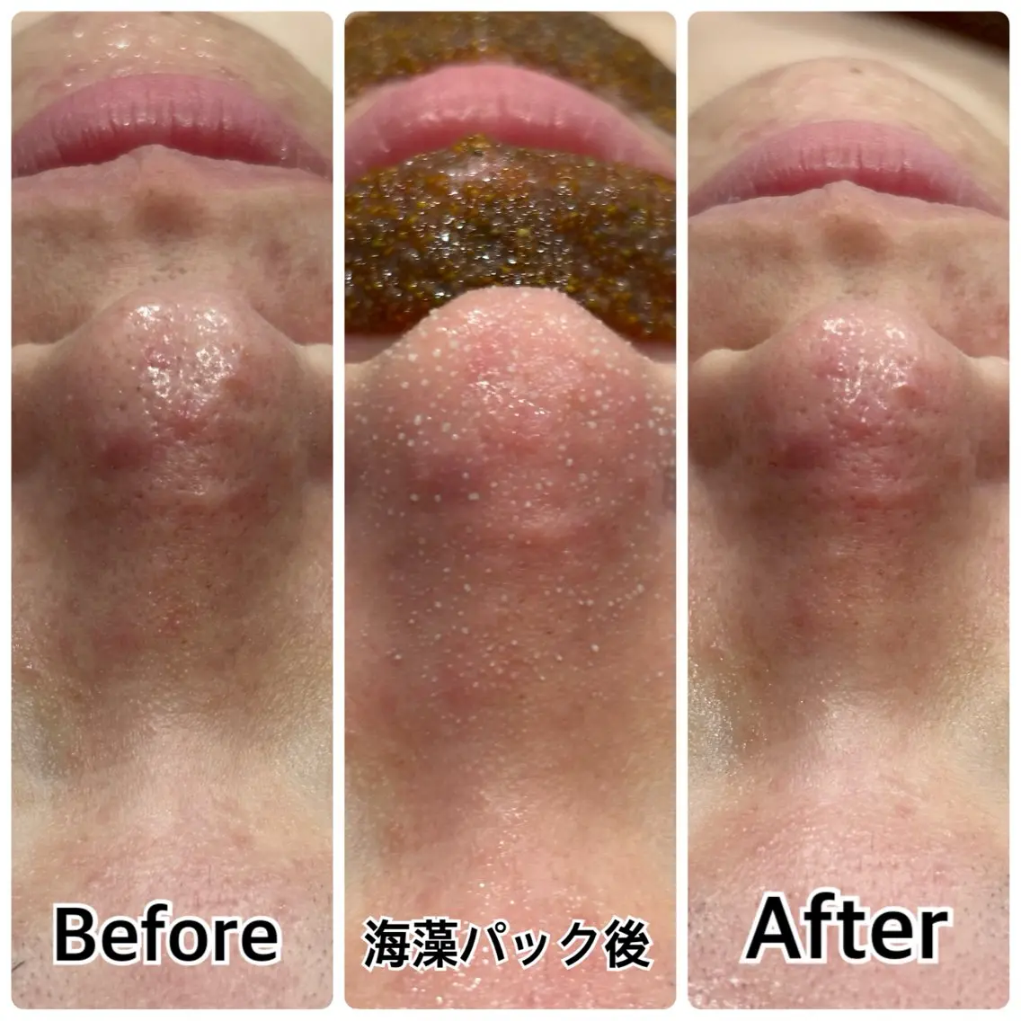 【新規女性/平日限定/この春褒められる肌作り】毛穴洗浄+顔無VIO込全身脱毛の写真