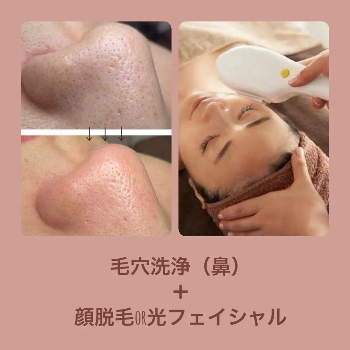 【完全都度払い】毛穴洗浄（鼻）＋顔脱毛or光フォトの写真