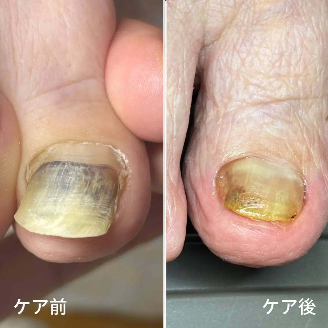 ネイル 巻き爪・肥厚爪ケア 専門サンセリテのネイルデザイン