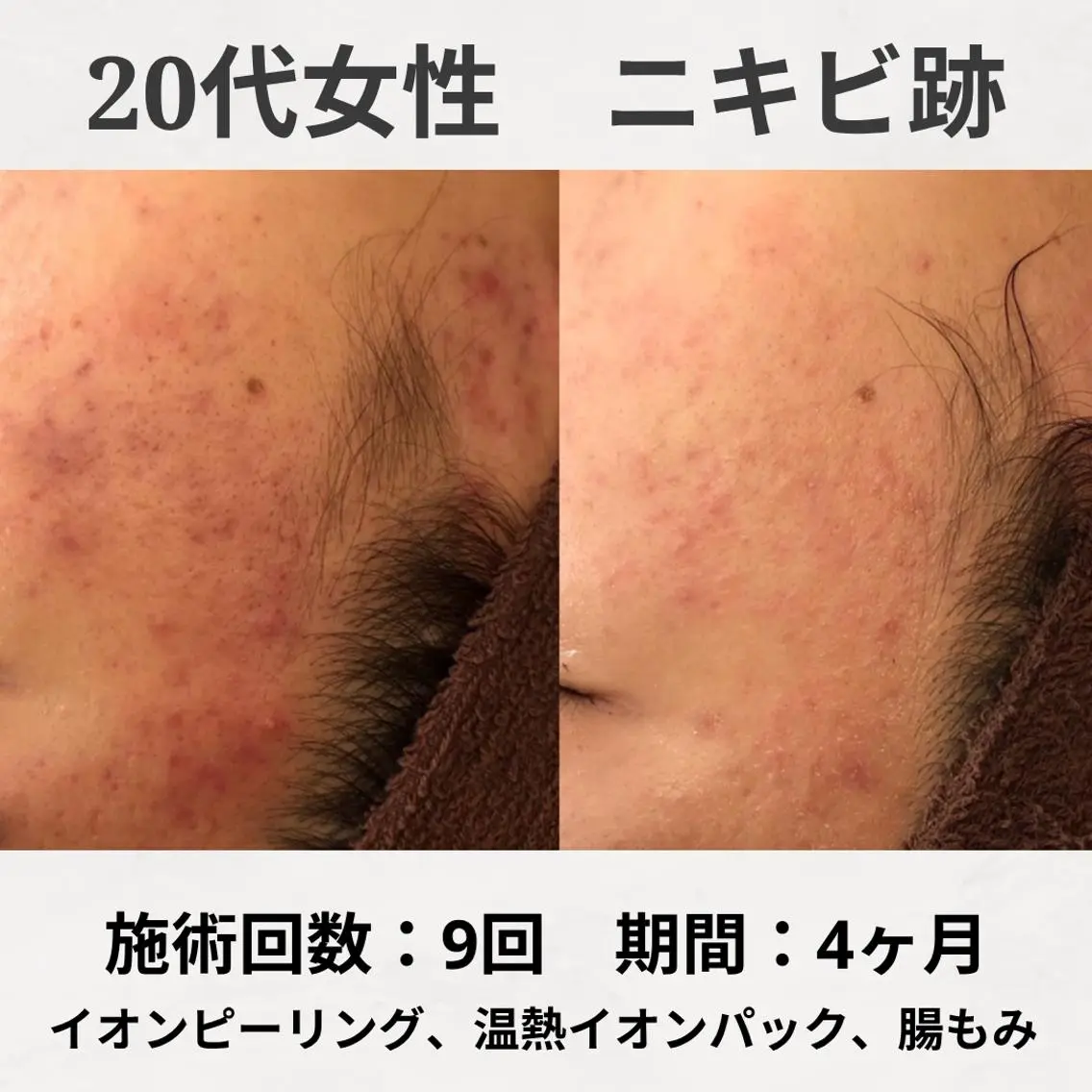 エステ リラク ニキビ跡改善専門🔥 医療にはできない改善のエステ・リラクイメージ
