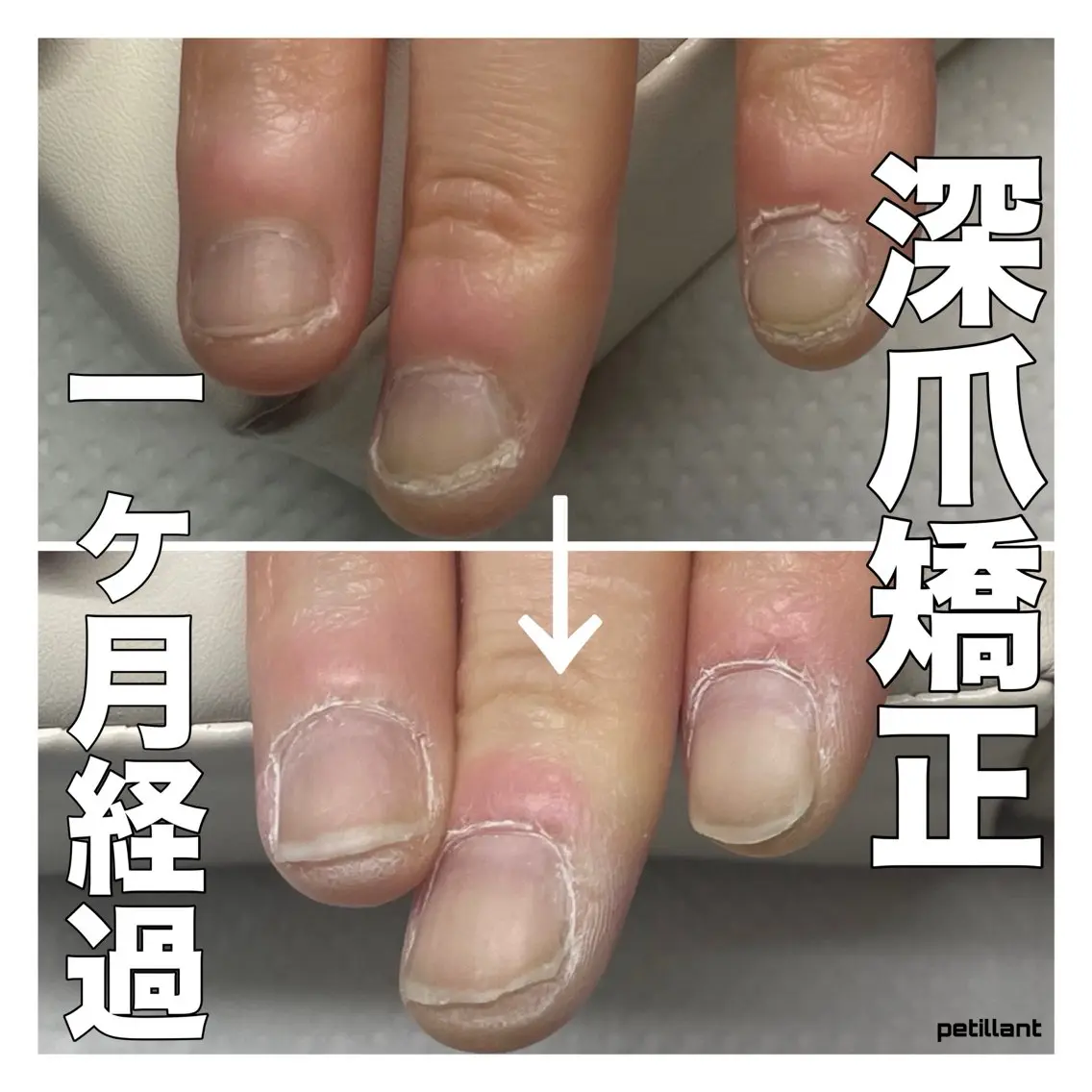 ネイル クリアネイル 長さ出し ジェルネイル nail salon petillantのネイルデザイン