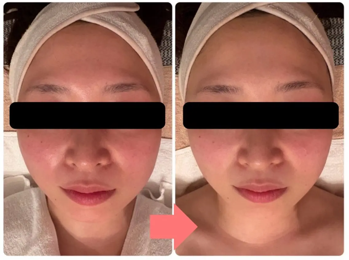 エステ×酵素パックの力でキメの整いを実感!の写真