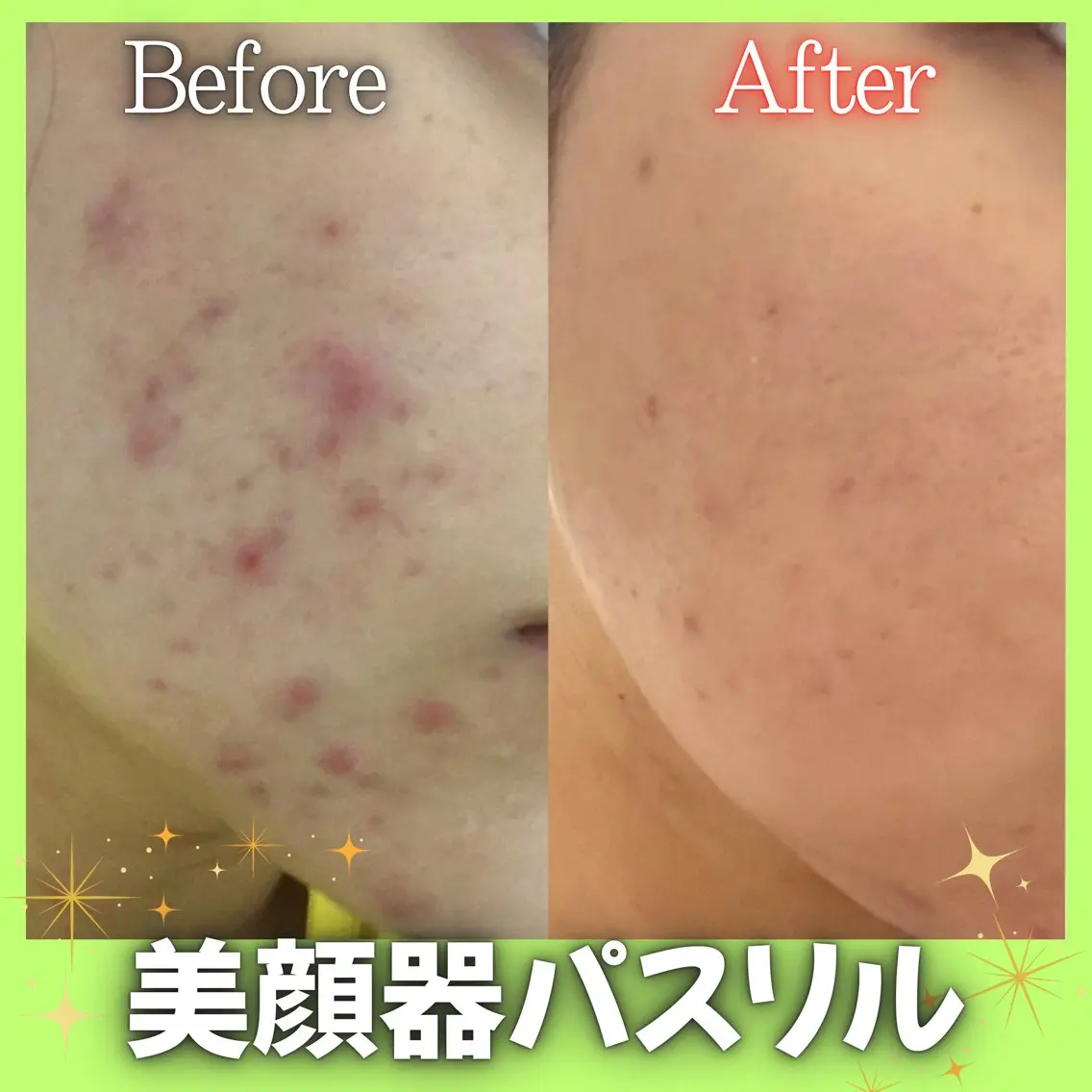 【パスリル購入希望者限定】新美顔器パスリルリュクス体験ੈ✩‧₊˚たった5分で-3㎏小顔・美肌に導く美顔器🕊️の写真