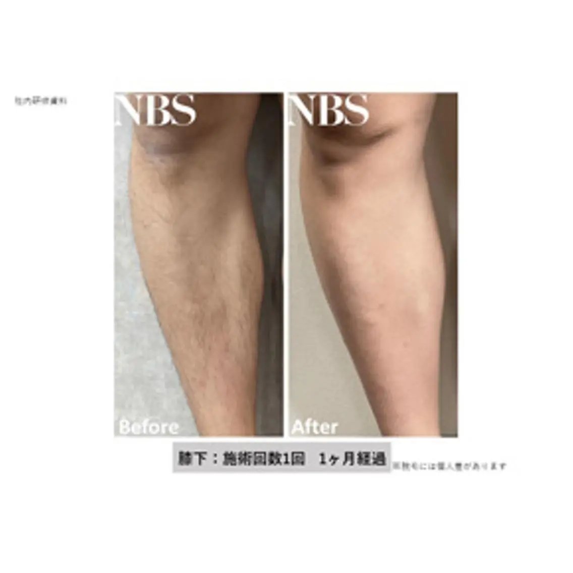 【メンズ脱毛】 両アシ ¥2750の写真