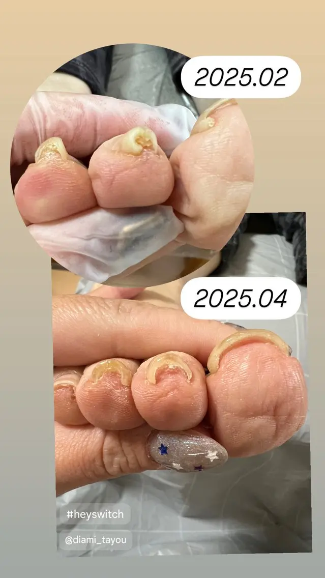【巻き爪モデル】巻き爪施術の写真