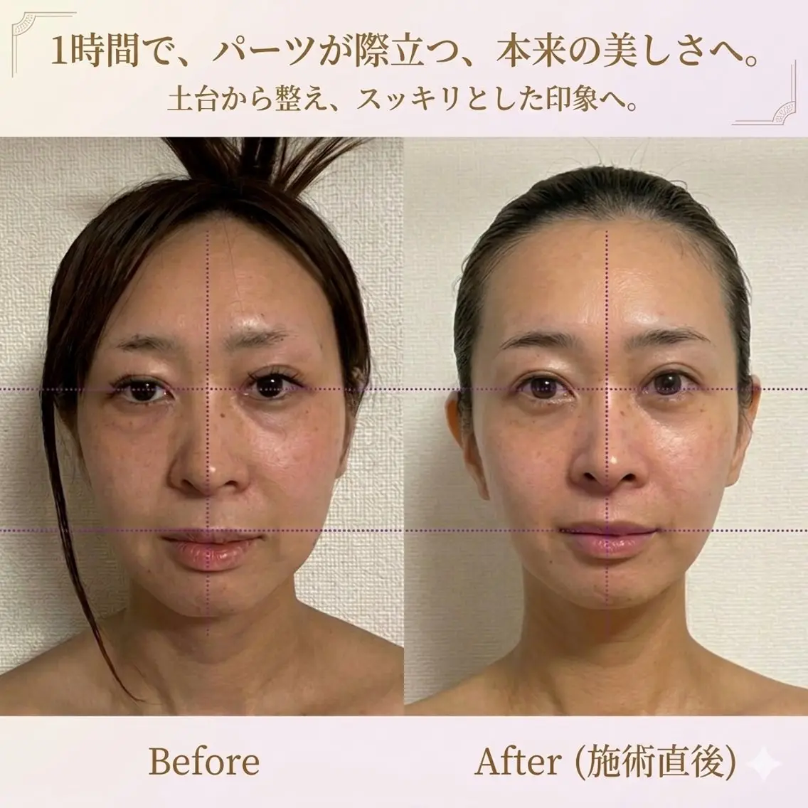 【姿勢×バストまわりケア✨】IW波で背中から整える✨本格フェイシャル×デコルテケアでうる肌＆首肩スッキリ♡の写真
