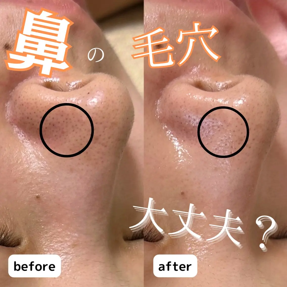 黒ずみ毛穴/ポツポツ毛穴/鼻の黒ずみ👃フェイシャル&デコルテ背中マッサージ込み🤍【角栓毛穴洗浄フェイシャル】の写真