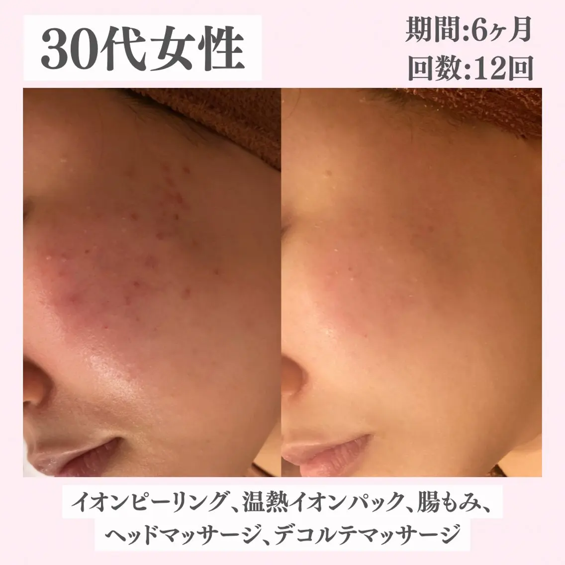 エステ リラク ニキビ・肌質改善専門 ♡人生が変わるサロンのエステ・リラクイメージ