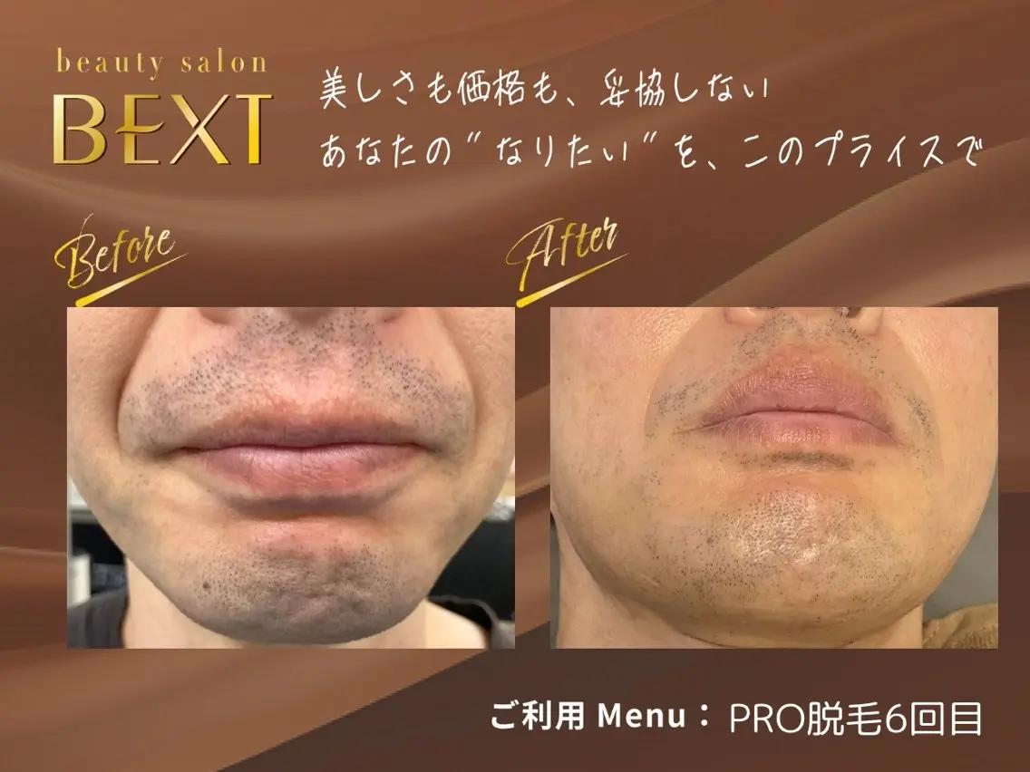 結果重視|お顔・おヒゲ脱毛|自己処理から卒業♪清潔感UPで好印象の写真