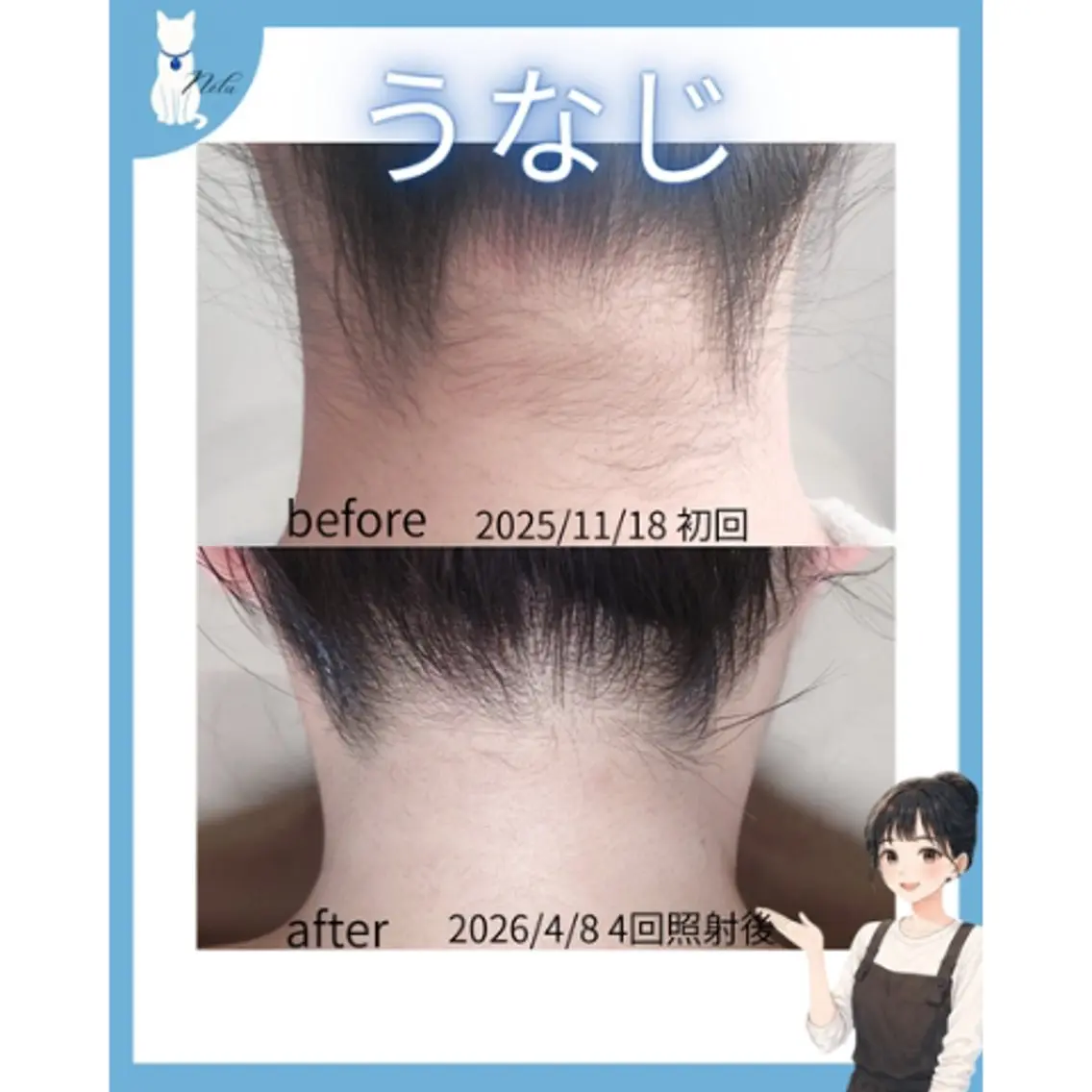 【女性限定🎀】Ｍパーツ脱毛【顔 or うなじ or VIO】の写真