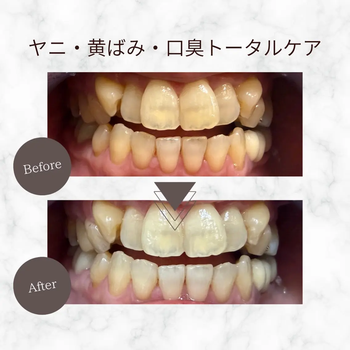 エステ リラク セルフホワイトニング PAOのその他イメージ
