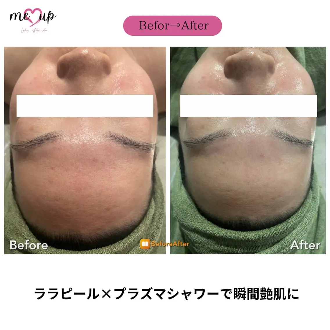 エステ Meupニキビ専門店 背中/ハーブ/肌管理のその他イメージ
