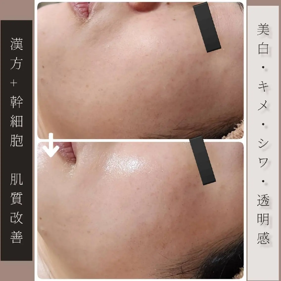 【憧れのツルツル陶器肌】剥離なし肌質改善ハーブピーリングの写真