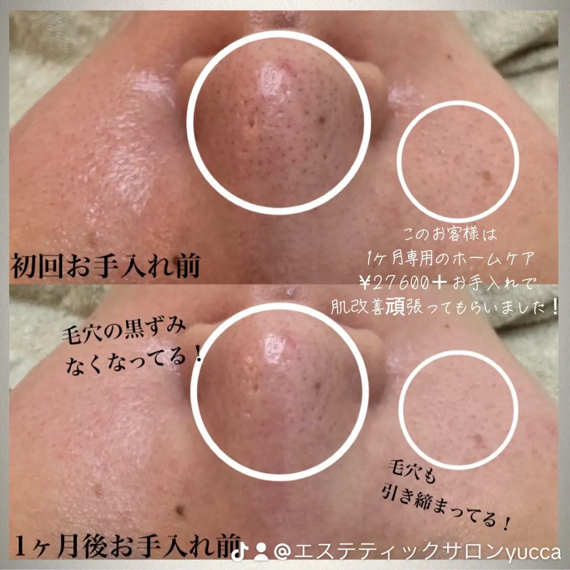 【人気No. 1】集中毛穴ケア 陶器肌・ノーファンデフェイシャル90分¥16500→7500(4/15〜価格改定予定)の写真
