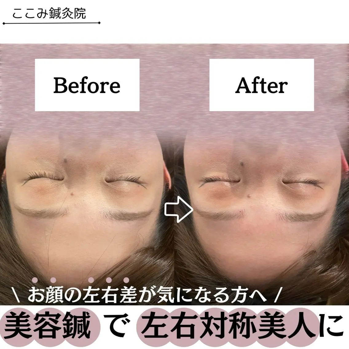 美容鍼/鍼灸 ここみ鍼灸院のエステ・リラクイメージ