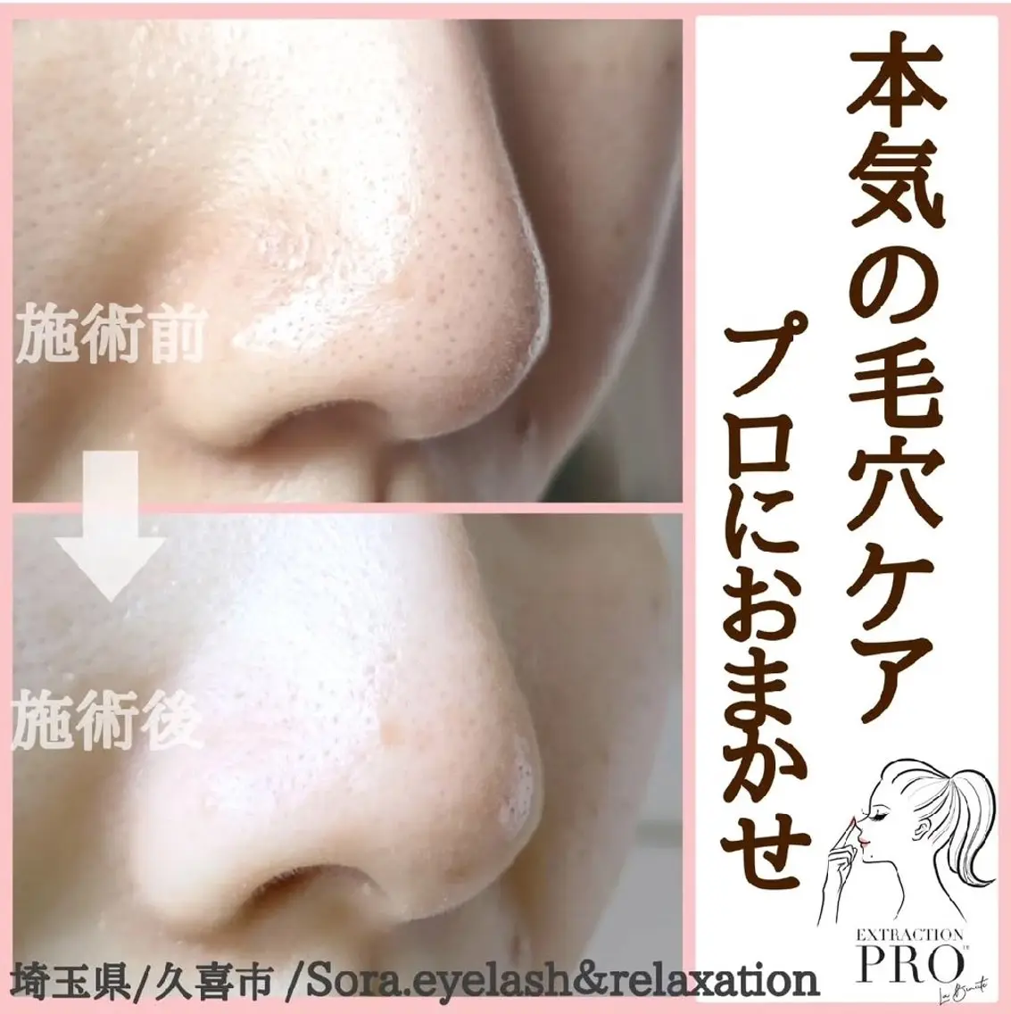 毛穴洗浄&リフトUPエステ  ￥6480⇒￥4980の写真