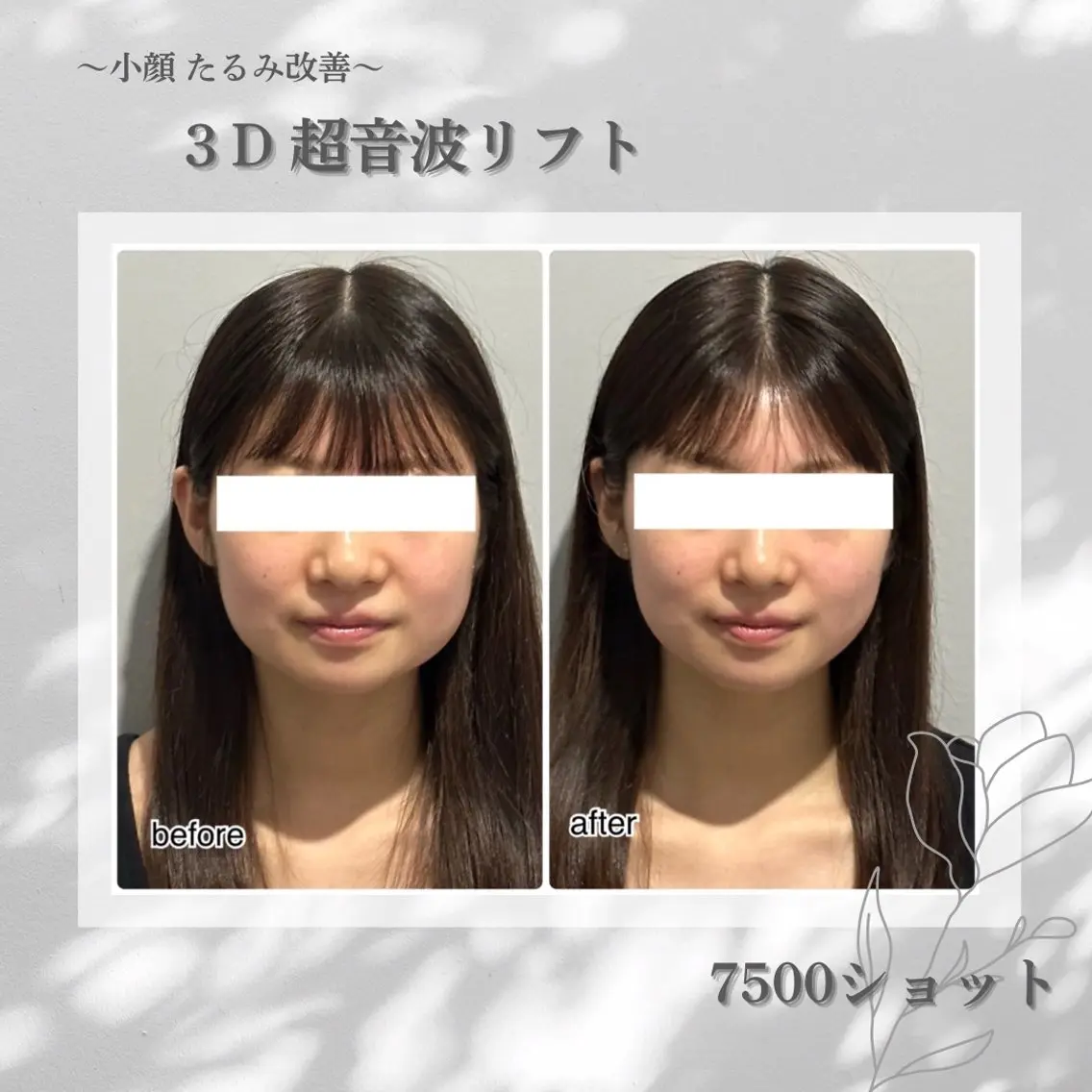 【小顔&たるみ改善】3D超音波リフト🌟お顔の脂肪を撃沈‼︎リフトアップ&毛穴引き締め,ハリ弾力UP💆🏼♀️✨の写真