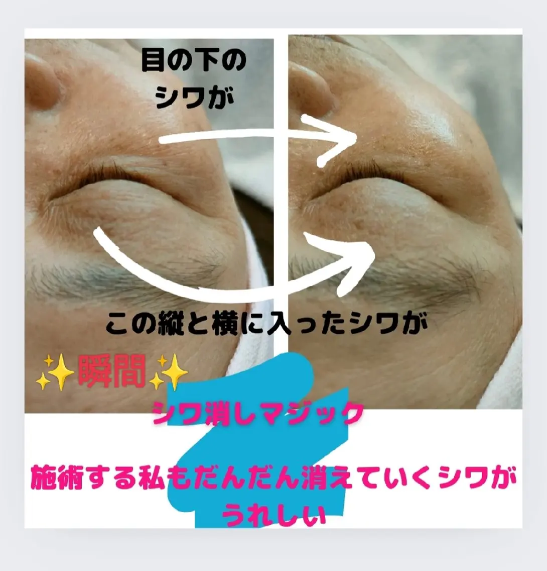 リピート率1️⃣土台ケアでハリ肌復活✨コラーゲン&ヒアルロン酸導入サロン限定ケア　70分の写真