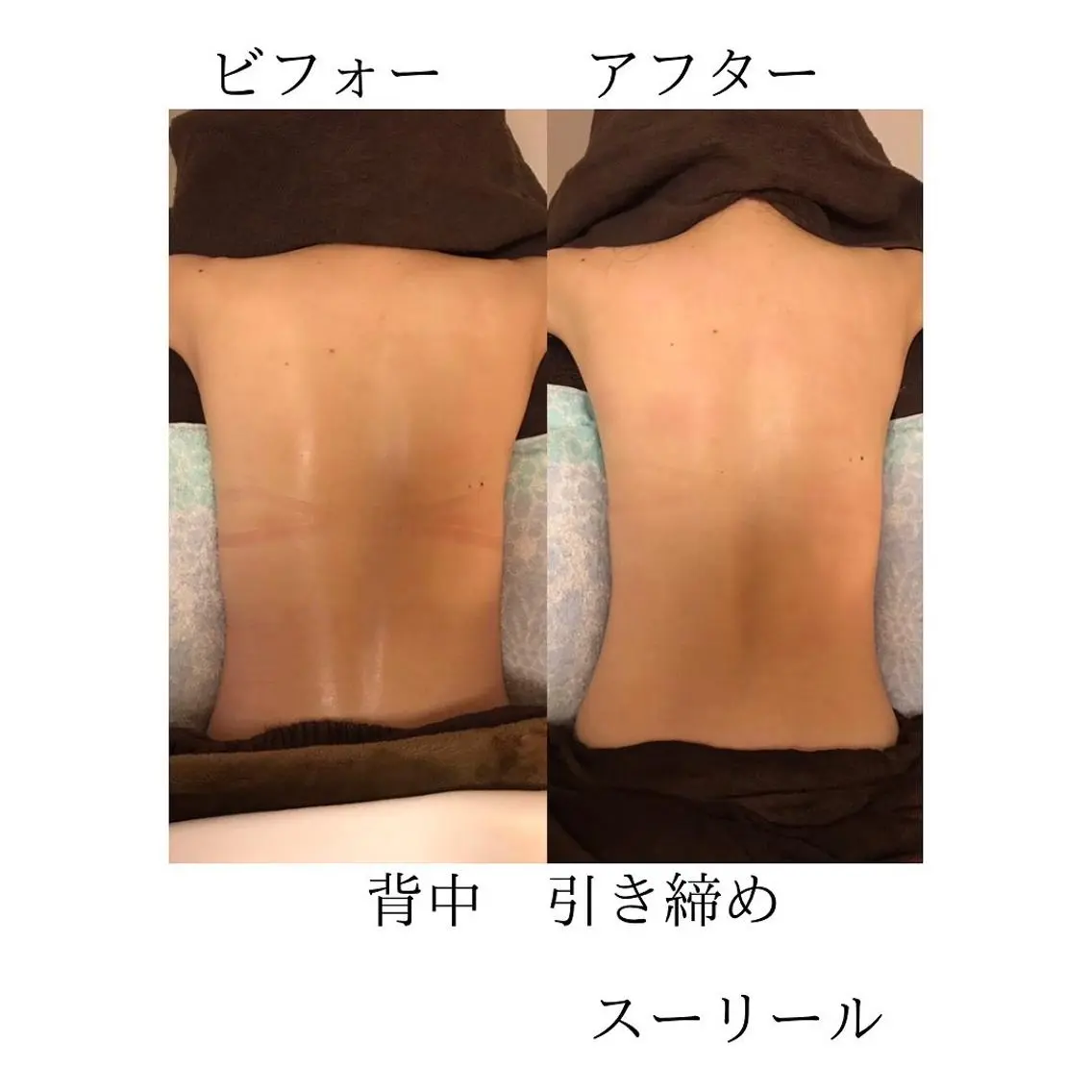 背中のニキビ 背中集中酵素エステ 背中ニキビ悩みから解放の写真