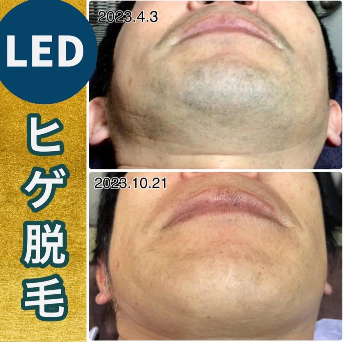 メンズ 脱毛 kozaki tomokoのエステ・リラクイメージ