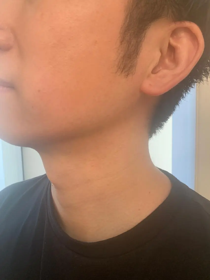 お好きなパーツ脱毛❤️ヒゲが人気の写真
