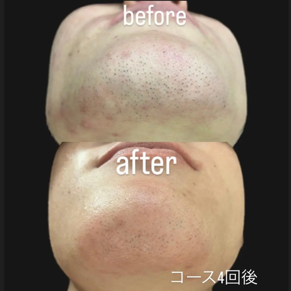 メンズ🩵【ヒゲ脱毛】痛み最小限✨の写真