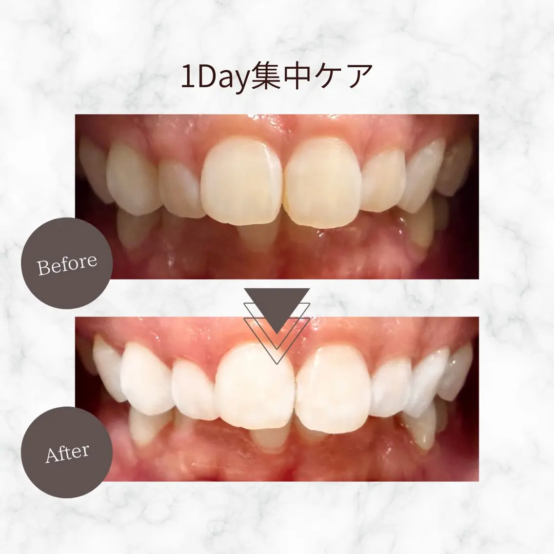 エステ リラク セルフホワイトニング PAOのその他イメージ