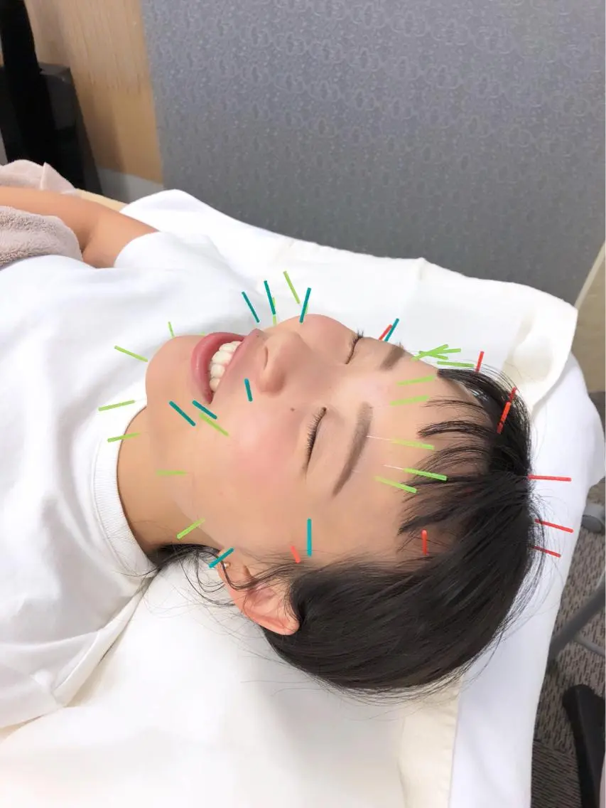 リガメント打ちリフト鍼の写真