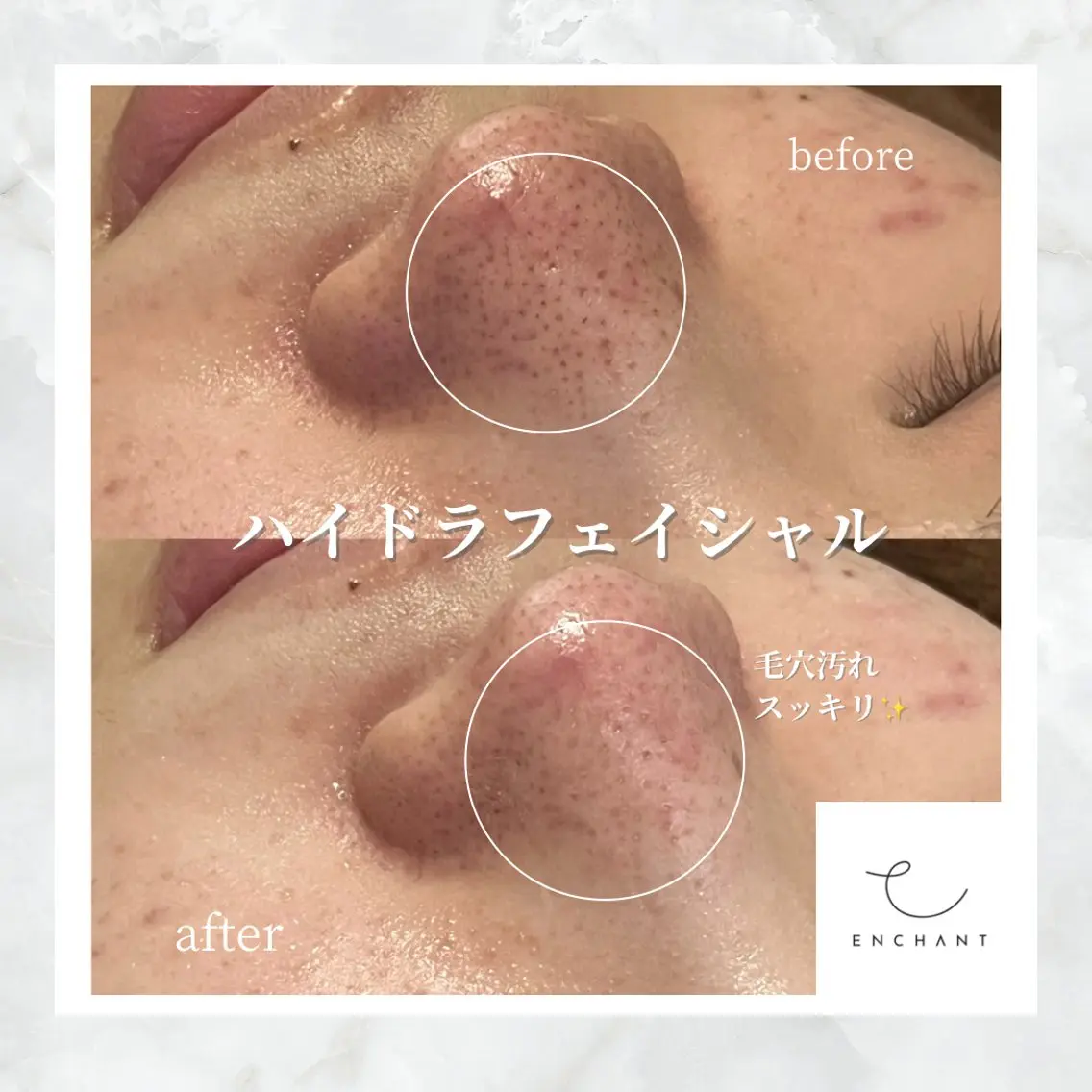 【当日限定価格】ハイドラフェイシャル(毛穴洗浄)🫧✨の写真