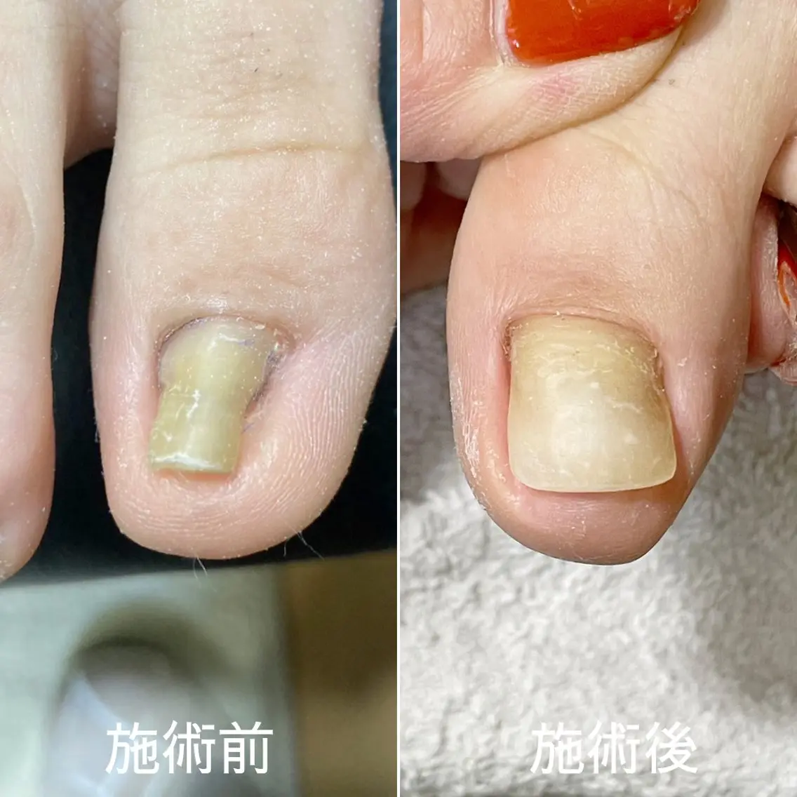 ネイル 巻き爪・肥厚爪ケア 専門サンセリテのネイルデザイン