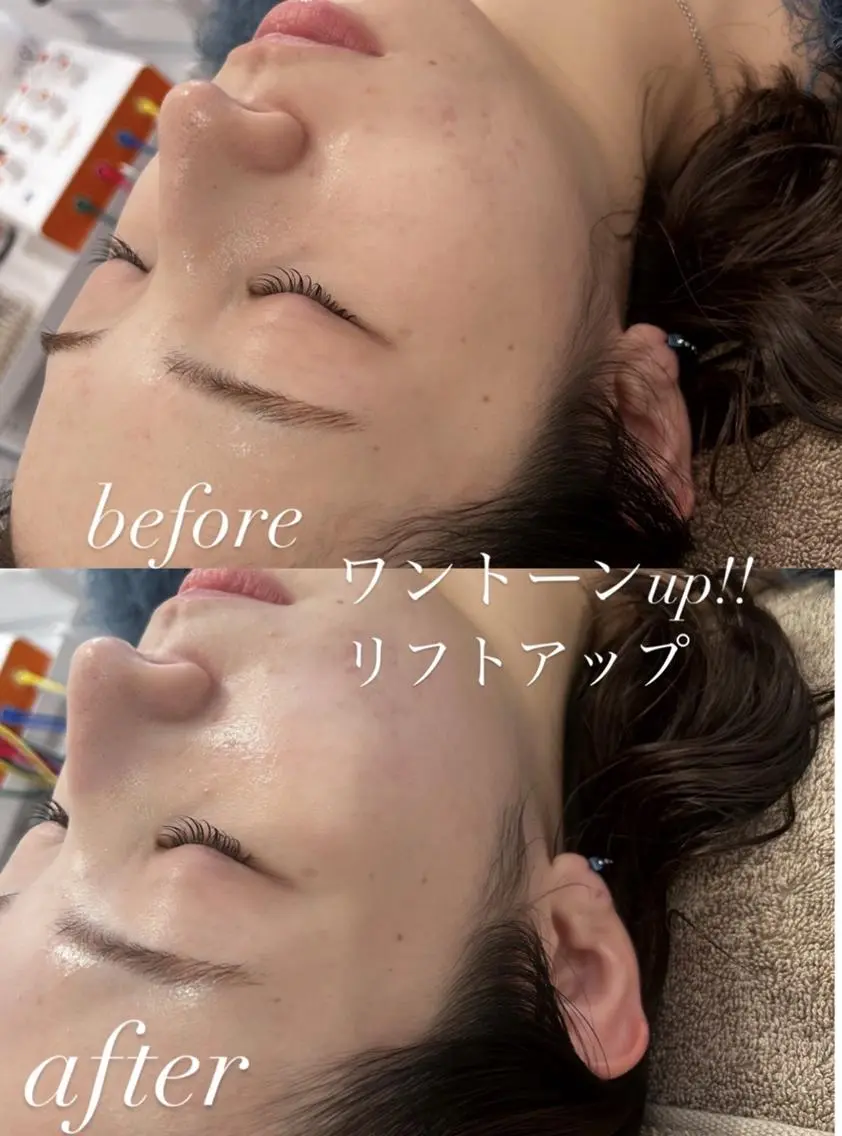 【全身代謝up🔥ツヤ肌毛穴レス小顔】 🇰🇷黄土よもぎ蒸し×電気美容鍼×毛穴洗浄ダイエット◎肌荒れ◎ニキビ◎毛穴◎の写真