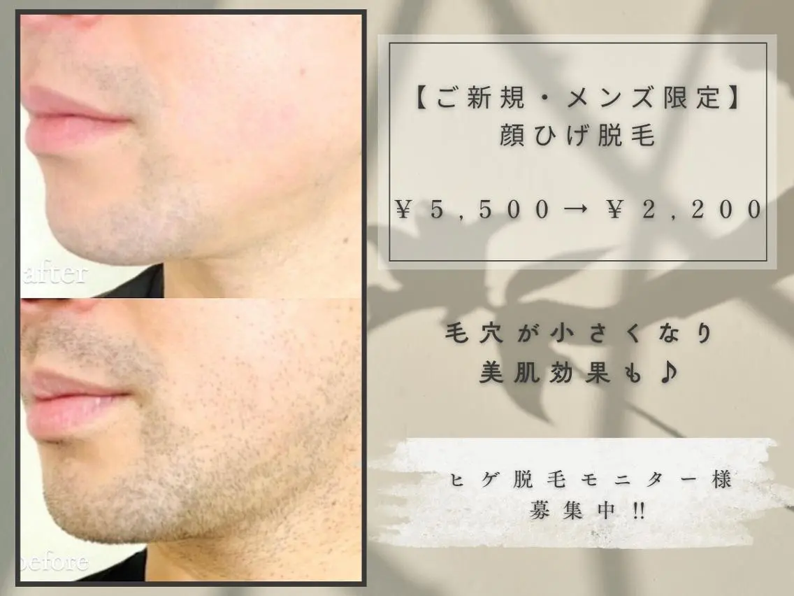 【ご新規・メンズ限定】顔ひげ脱毛　通常￥5,500→￥2,200の写真