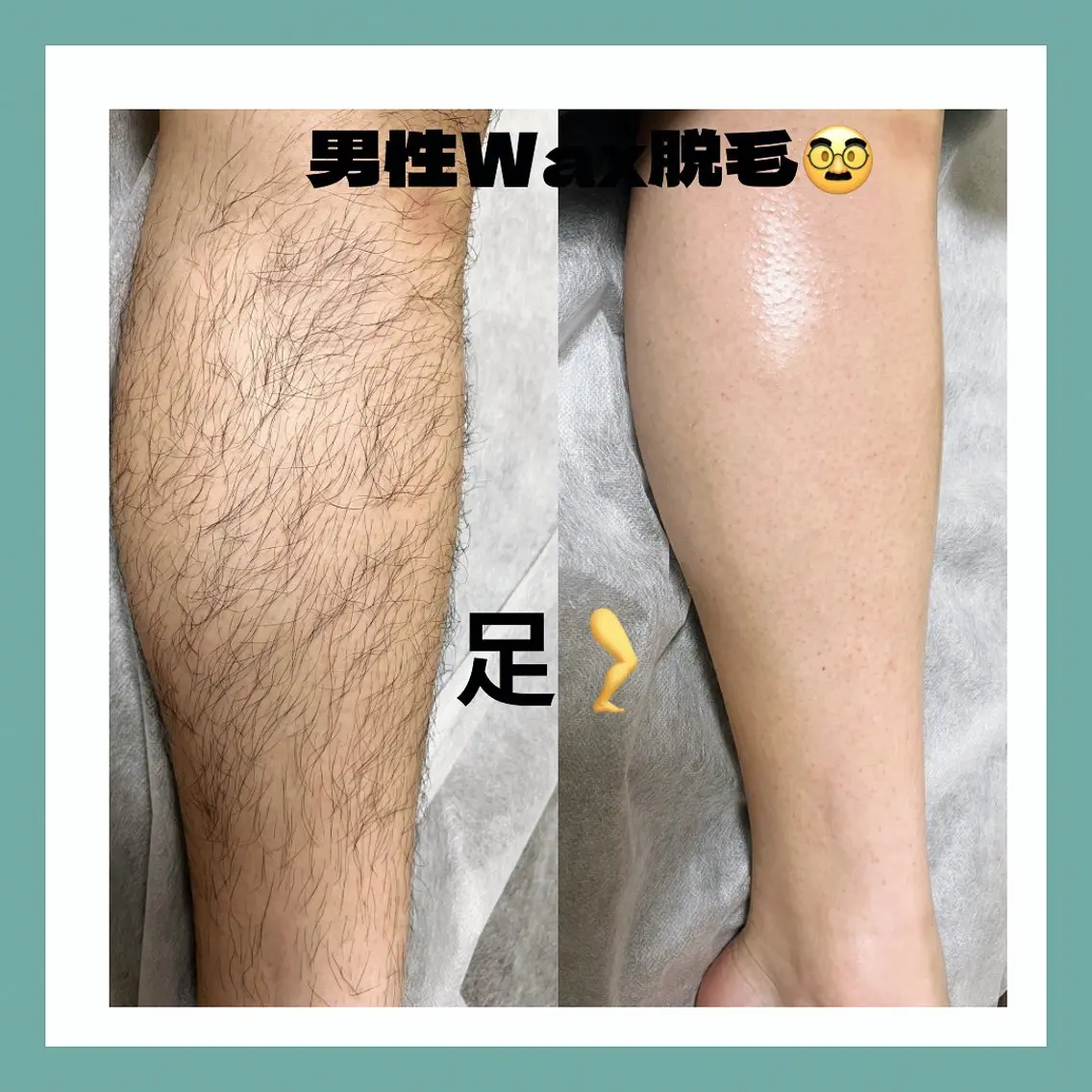 半ズボンも快適メンズ足脱毛🌿ワックス脱毛の写真