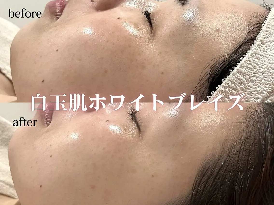【春の紫外線対策】ホワイトブレイズ🌙ちゅるんと玉のようなお肌に♡の写真