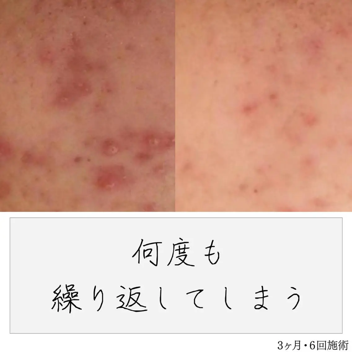 ニキビ経験者が施術 する専門サロン🌻のエステ・リラクイメージ
