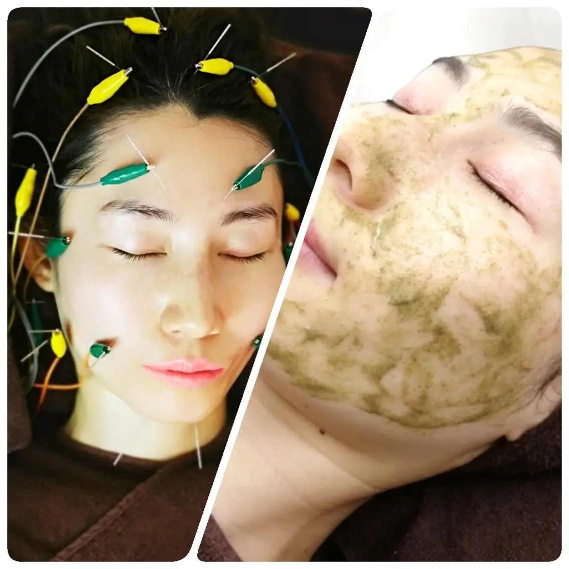 【透明感・ざらつき・ツヤ肌】ハーブピーリング🌿+電気を20ヶ所も流す美容鍼🪡【ニューハーフ鍼灸師の最強肌管理🌹】の写真