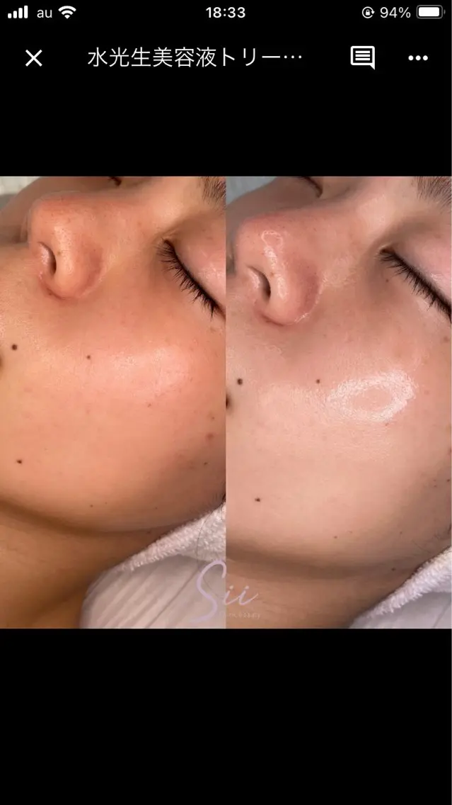 最強ツヤ肌☆水光生美容液ピーリング✨60minの写真