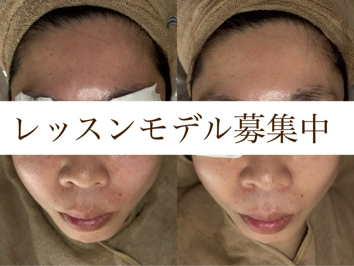 40代以上✨動画、写真撮影ご協力いただける方のみ✨フェイスラインスッキリ、くすみ解、（ご来店初めての方、女性限定）の写真