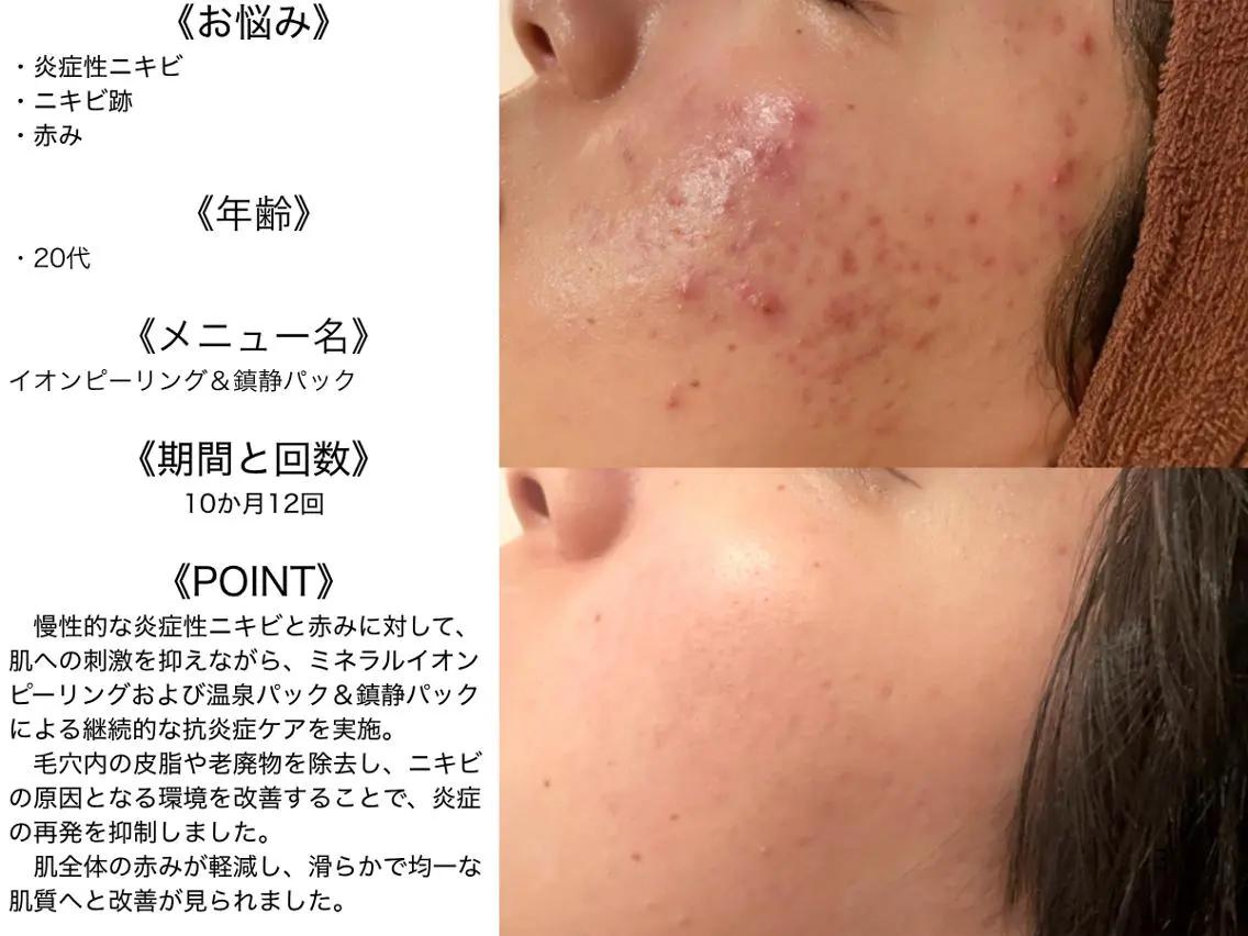 エステ リラク 3か月で肌革命👼 ニキビ専門店💫のエステ・リラクイメージ
