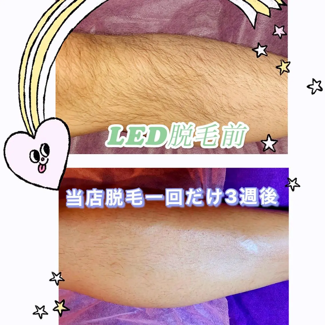 メンズ大人気120分脱毛＋全身クリームリンパ30000円→口コミ投稿18000円の写真
