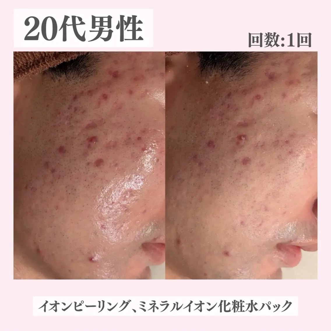 エステ リラク ニキビ・肌質改善専門 ♡人生が変わるサロンのエステ・リラクイメージ